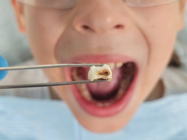 Best Emergency Root Canal Treatment in Hudson Lake, IN